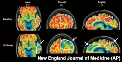 These PET scan images from January 2024 show a reduction in amyloid-beta levels in an Alzheimer's patient after focused ultrasound treatment to open the blood-brain barrier. Red is associated with higher levels of amyloid-beta levels. (New England Journal of Medicine via AP)