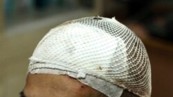 Quiz - Doctors Operate on the Brain to Treat Drug Addiction