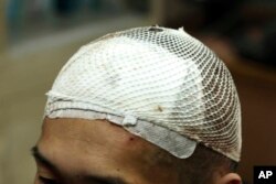 Bloodied white mesh covers the head of a methamphetamine user named Yan on Monday, Oct. 29, 2018, three days after he had a deep brain stimulation device implanted as part of a clinical trial at Ruijin Hospital in Shanghai, China.
