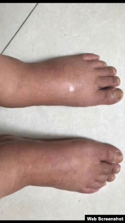 江天勇浮肿的双脚 （网络截图）