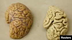FOne hemisphere of a healthy brain (L) is pictured next to one hemisphere of a brain of a person suffering from Alzheimer disease.